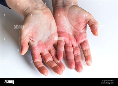 Dermatitis Atópica Roja Picazón En Las Manos Con Ampollas Y Piel