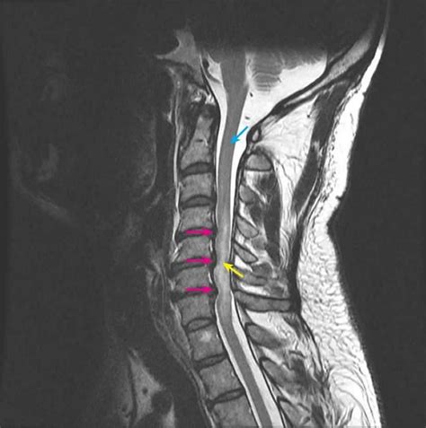 Spinal Cord Compression Neurologic Disorders Merck Manuals