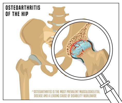 Hip Replacement Surgery Heres What You Need To Know Intellijoint