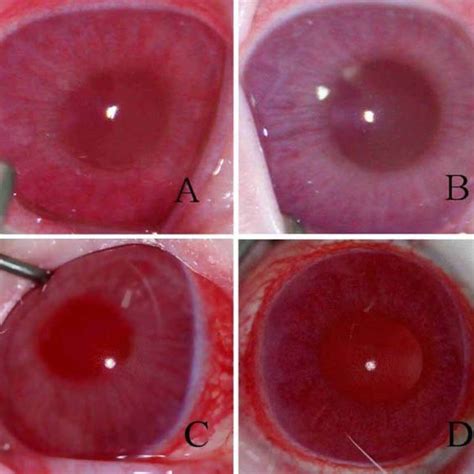 In The Treated Eye Dilated Iris Blood Vessel And Hazy Anterior Chamber