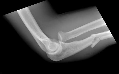 Isolated Ulnar Shaft Fracture Trauma Orthobullets