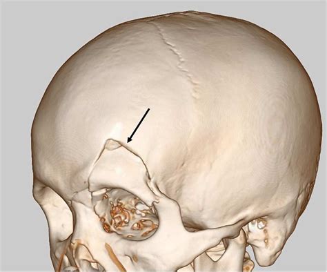 Head Ct Scan Revealed Open Skull Fracture Reaching The Left Skull Base
