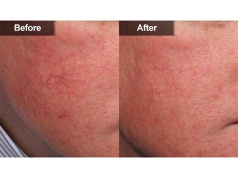 Red Spots And Vein Removal Mclean And Woodbridge Virginia Skin And Laser