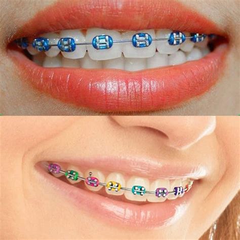 Orthodontic Ligature Ties Multi Color Orthodontic Elastomeric O Rings Braces Rubber Bands