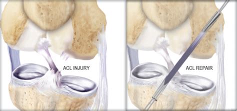 What Is An Acl Injury Sporting Life Arkansas