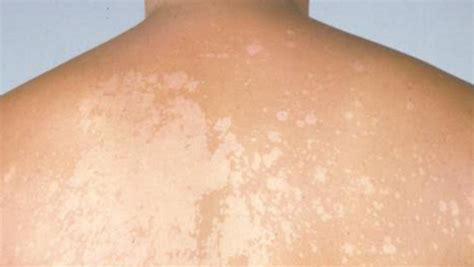 Small Itchy Dry Patches On Skin Atopic Dermatitis Symptoms