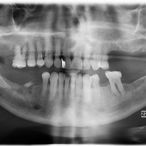 Panoramic Radiograph Showing Complete Obliteration Of Bilateral