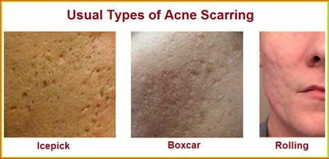 Types Of Acne Scars Skinhampshire Wrinkle Reduction Treatment In
