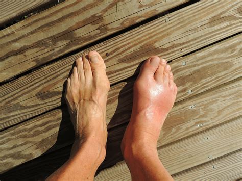 8 Dangerous Medical Conditions Linked To Swollen Feet David Avocado Wolfe