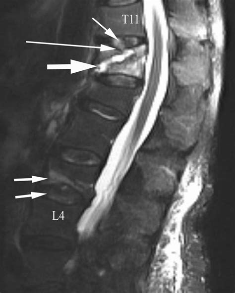 A 79 Year Old Woman With A 6 Week History Of Low Back Pain