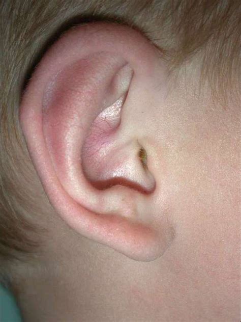 Otoplasty Pinnaplasty Surgery At Londons Ear Correction Centre Uk