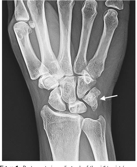 Woman With Wrist Pain After Falling Isolated Pisiform Dislocation
