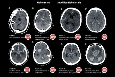 Subarachnoid Hemorrhage Fisher Scale Radiolog A Neurolog A