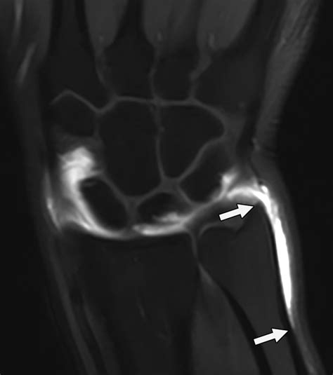 The Relevance Of Ulnar Sided Contrast Extravasation During Radiocarpal
