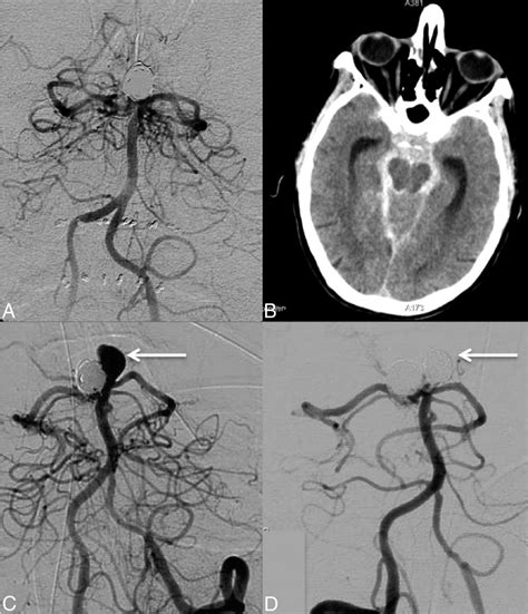 Clinical And Imaging Follow Up Of Patients With Coiled Basilar Tip Aneurysms Up To Years