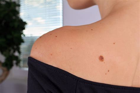 Moles Skin Tags And Freckles Cosmedica