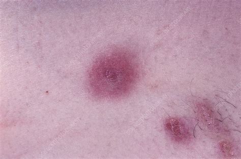 Mrsa Abcess On Human Skin Stock Image C0056366 Science Photo Library