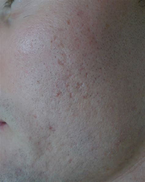 46 Ice Pick Scars Laser Treatment Png Just Sharing