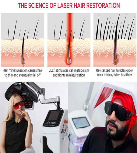 Hair Clinic Low Level Laser Therapy