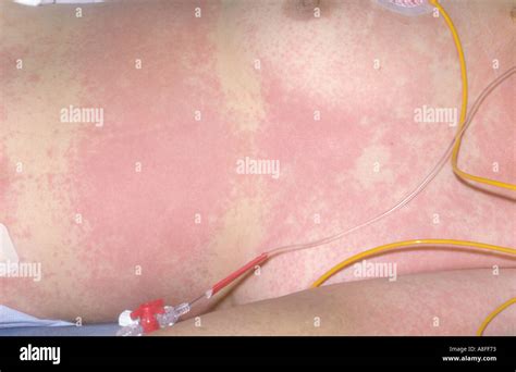 Child Measles Rash Hi Res Stock Photography And Images Alamy