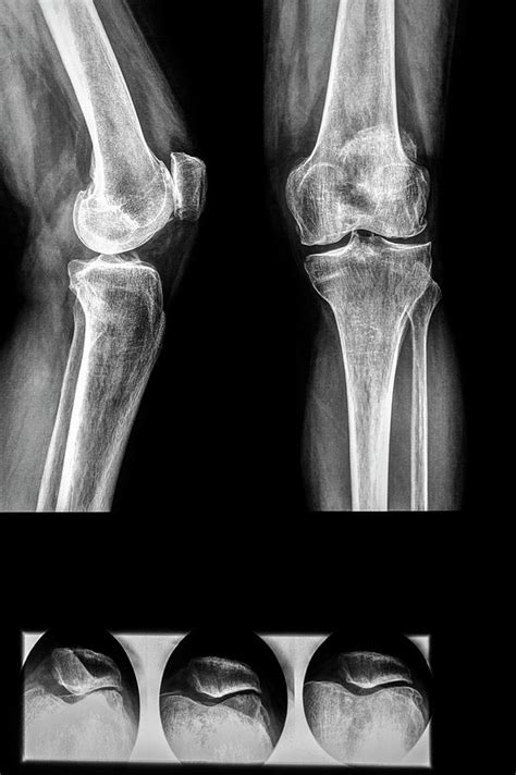 Diagnostic Knee And Knee Cap X Rays Photograph By Brian Gadsbyscience Photo Library Pixels