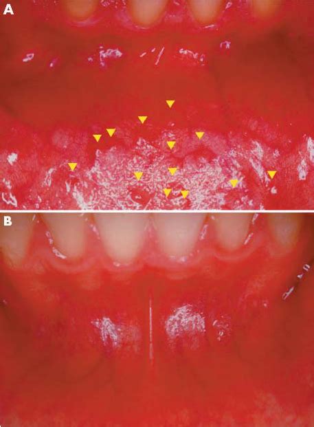 A Fordyce Granules Fgs Arrowheads In The Oral Vestibular Mucosa