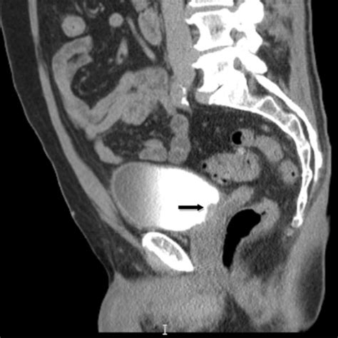 Ct Abdomen Pelvis With Initial Diagnosis Of Bladder Cancer Download