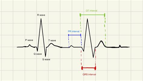 Solved Draw And Label An Ecg Tracing For A Normal Sinus Rhythm And
