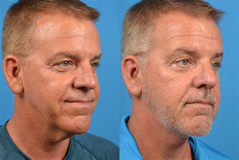 Patient 122406479 Profile Neck Lift Before And After Photos Clevens Face And Body Specialists