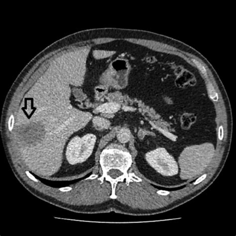 Ct Axial Scan Venous Phase A Lesion Was Located In Liver Segments Vi