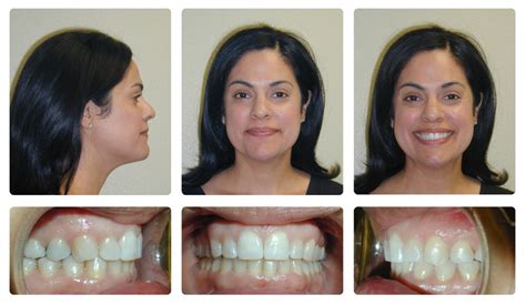 Invisalign Before And After Severe Crowding