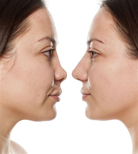 Opt For A Safer Procedure To Reshape Or Improve Your Nose By