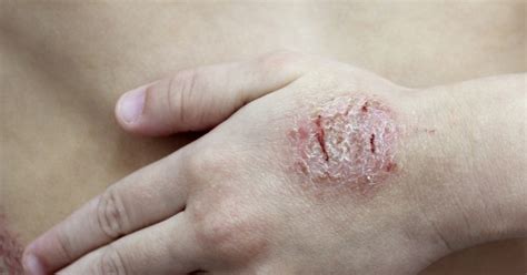 Nummular Eczema Inner Elbow Images Edison Health