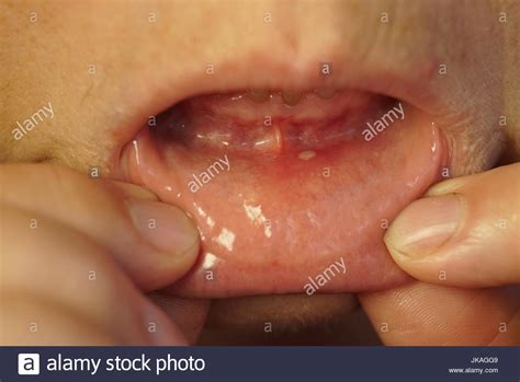 Mouth Ulcer Hi Res Stock Photography And Images Alamy