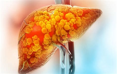 Na bolesti jetre upozorava nas više različitih simptoma eKlinika