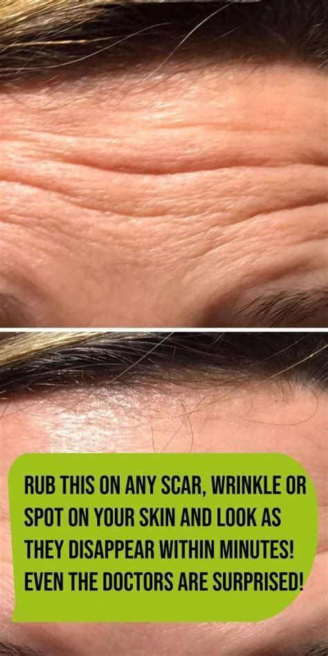Rub This On Any Scar Wrinkle Or Spot On Your Skin And Look As They
