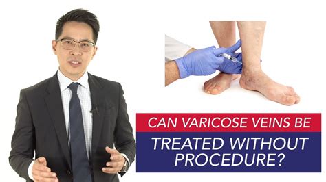 Can Varicose Veins Be Treated Without Procedure Youtube