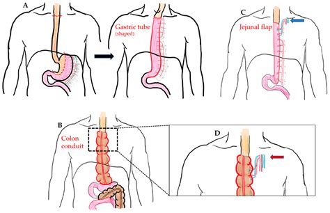 Jcm Free Full Text A Comparison Of Different Types Of Esophageal