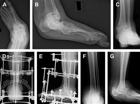 Surgical Reconstruction Of The Diabetic Charcot Foot Clinics In