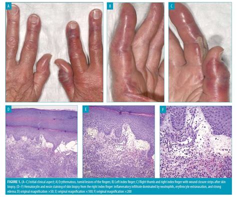 The Initial Stage Of Neutrophilic Dermatosis Of The Dorsal Hands A
