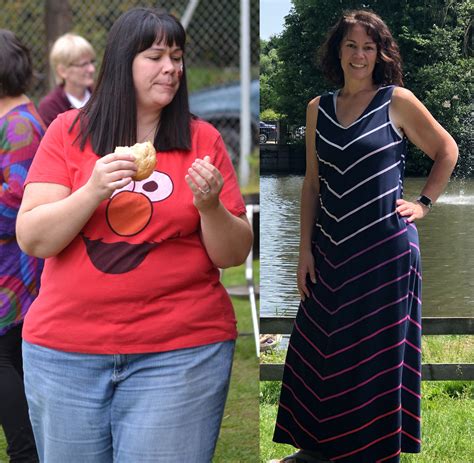 Weight Loss Surgery Before And After Photos Nordbariatric Clinic