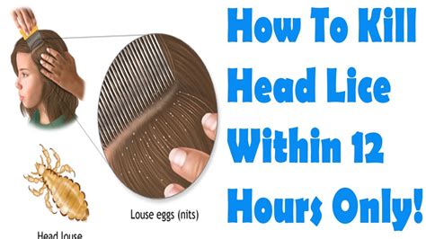 How To Get Rid Of Lice Overnight How To Kill Head Lice Within 12 Hours Only Youtube