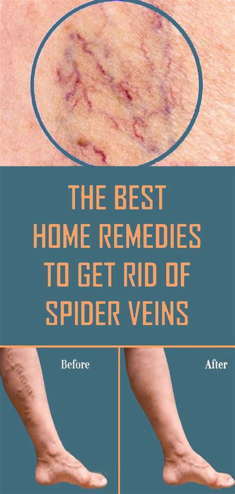 The Best Home Remedies To Get Rid Of Spider Veins Wellness Webs