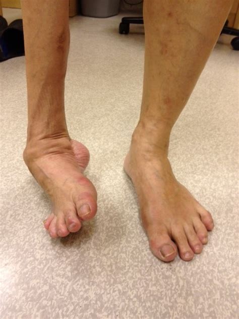 Foot Deformity Singapore Surgery Reconstruction Treatment