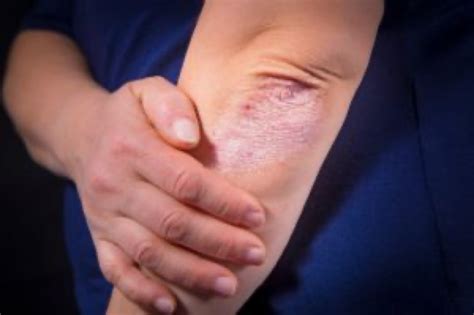 Psoriatic Arthritis The Early Signs And Treatment Options
