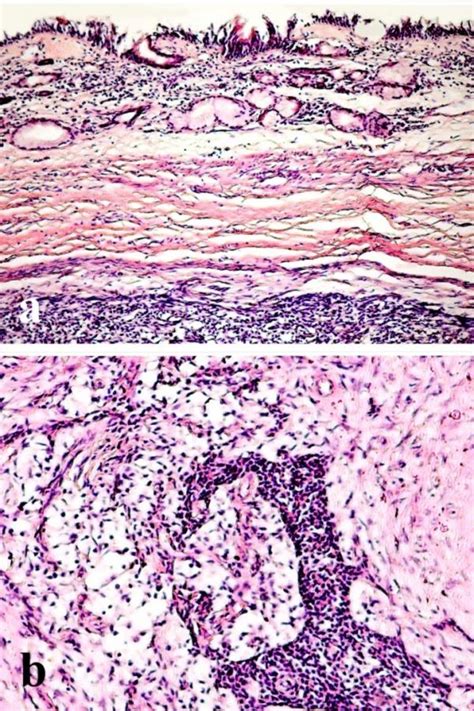 Pleomorphic Adenoma Of The Nasal Septum Pleomorphic Adenoma Of The