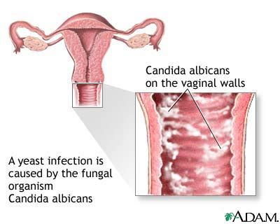 Candidoza Vaginala Si Bucala Cauze Simptome Tratament Poze