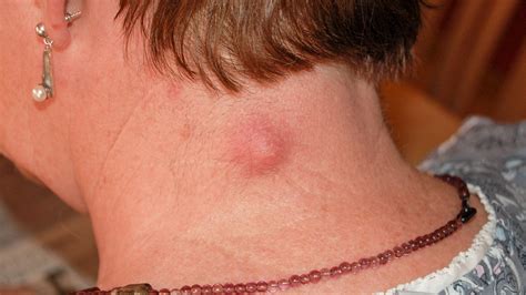Handling Of Lumps In The Back Of The Neck Healthreplies
