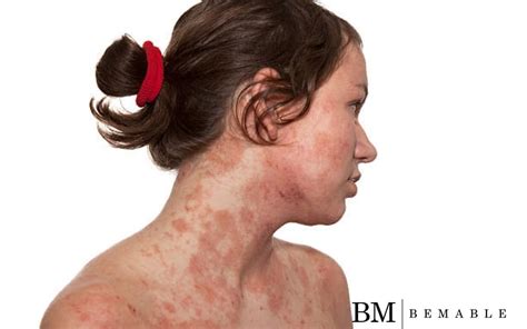 Eczema Atopic Dermatitis Types Causes Symptoms Treatment