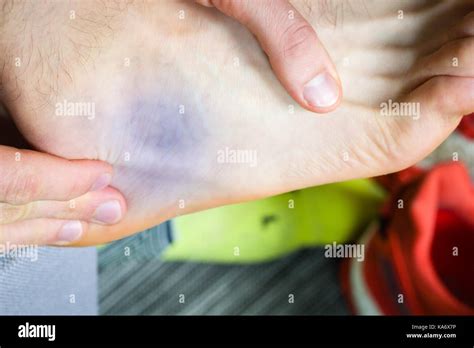 Bruise Near Ankle Common Runners Contusion Stock Photo Alamy